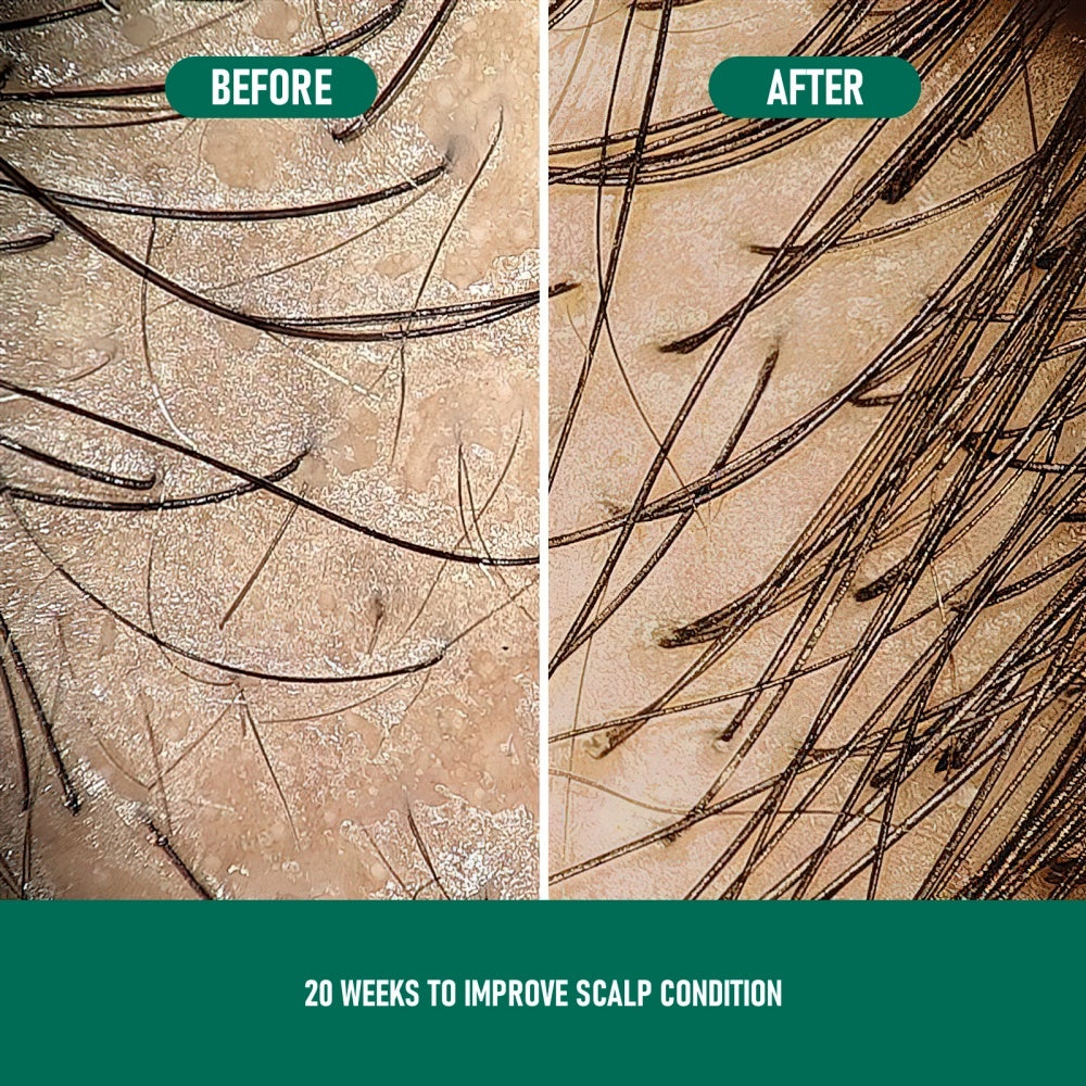 Minoxidil Anti-Hair Loss Mousse
