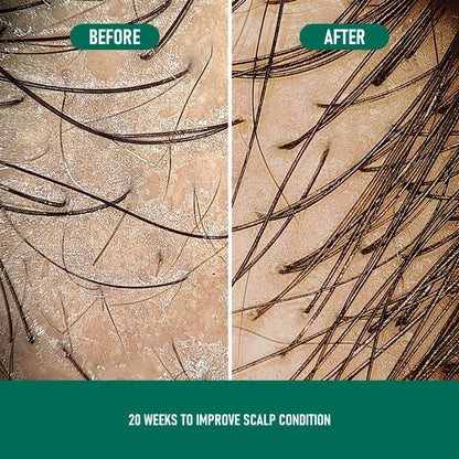 Minoxidil Anti-Hair Loss Mousse
