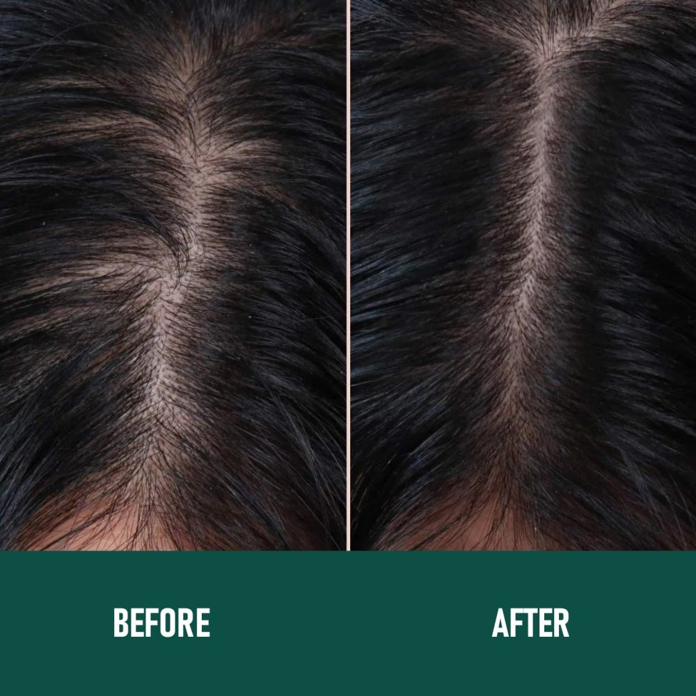 Minoxidil Anti-Hair Loss Mousse