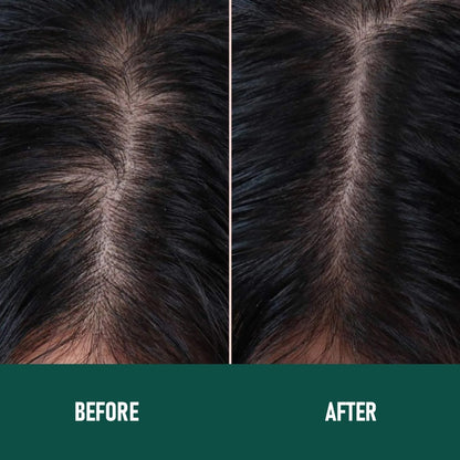 Minoxidil Anti-Hair Loss Mousse