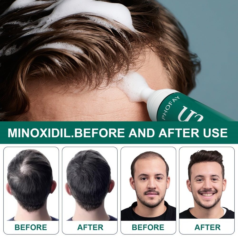 Minoxidil Anti-Hair Loss Mousse