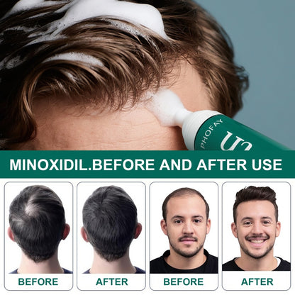Minoxidil Anti-Hair Loss Mousse